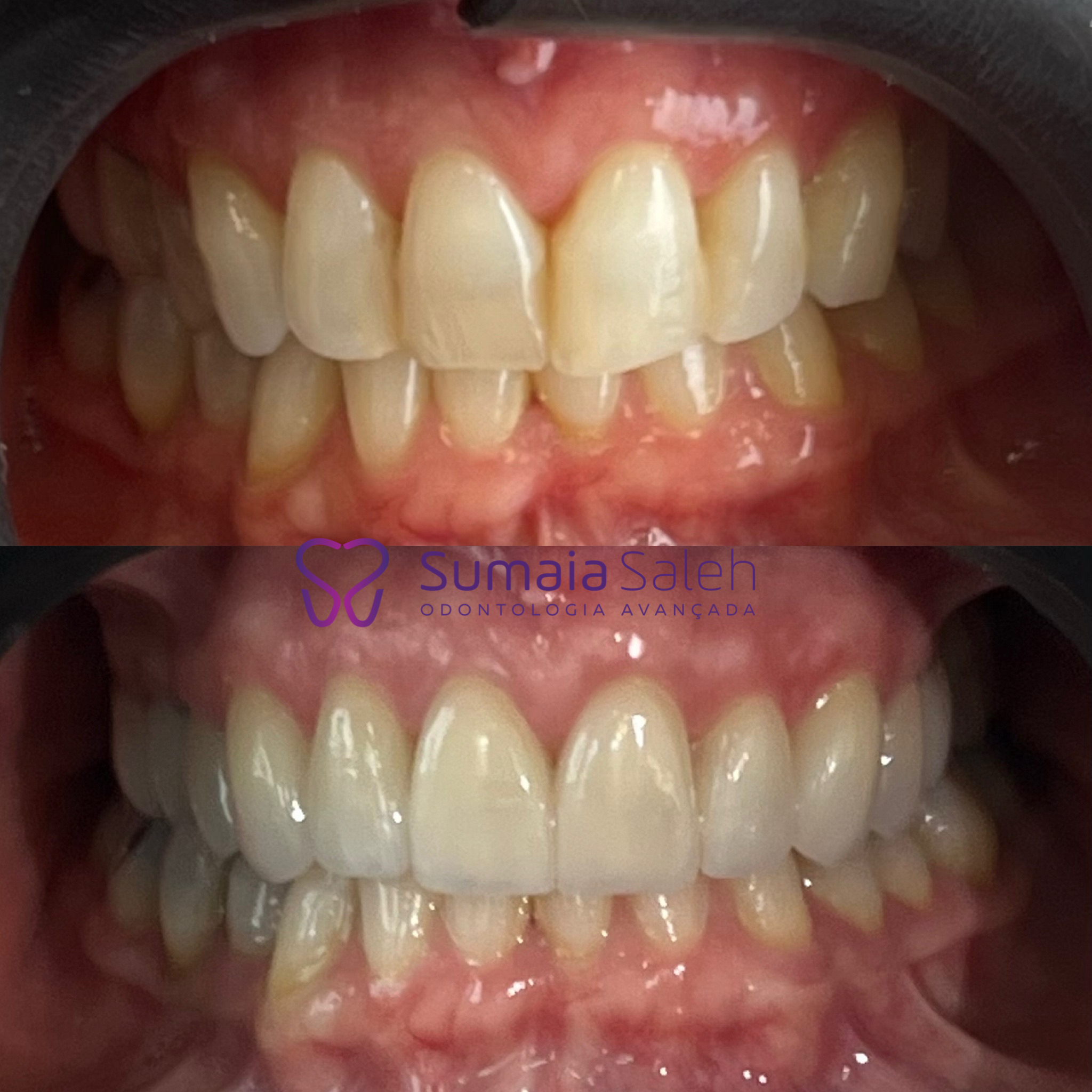 Resultado antes e depois — clareamento dental com resultado natural