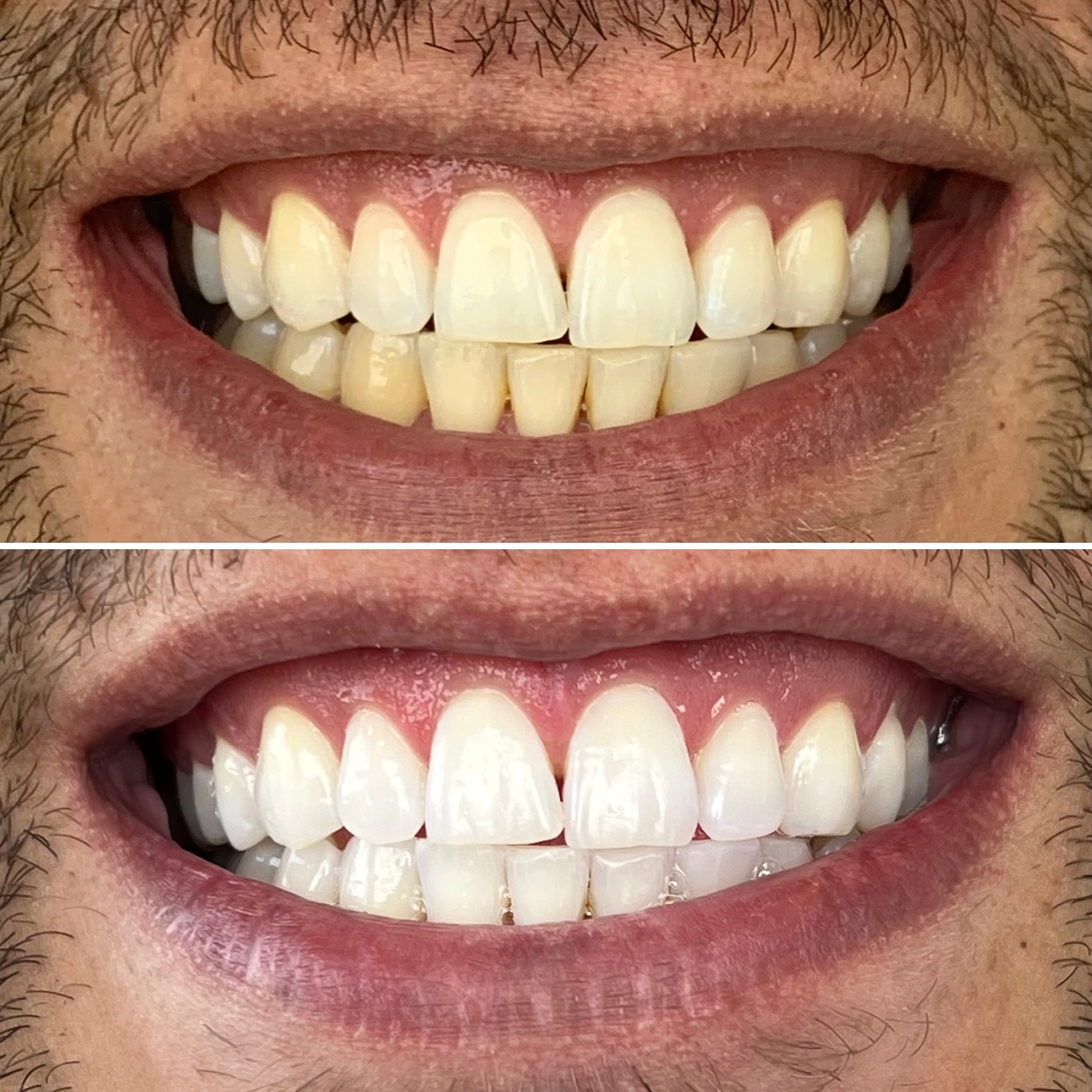 Clareamento Dental