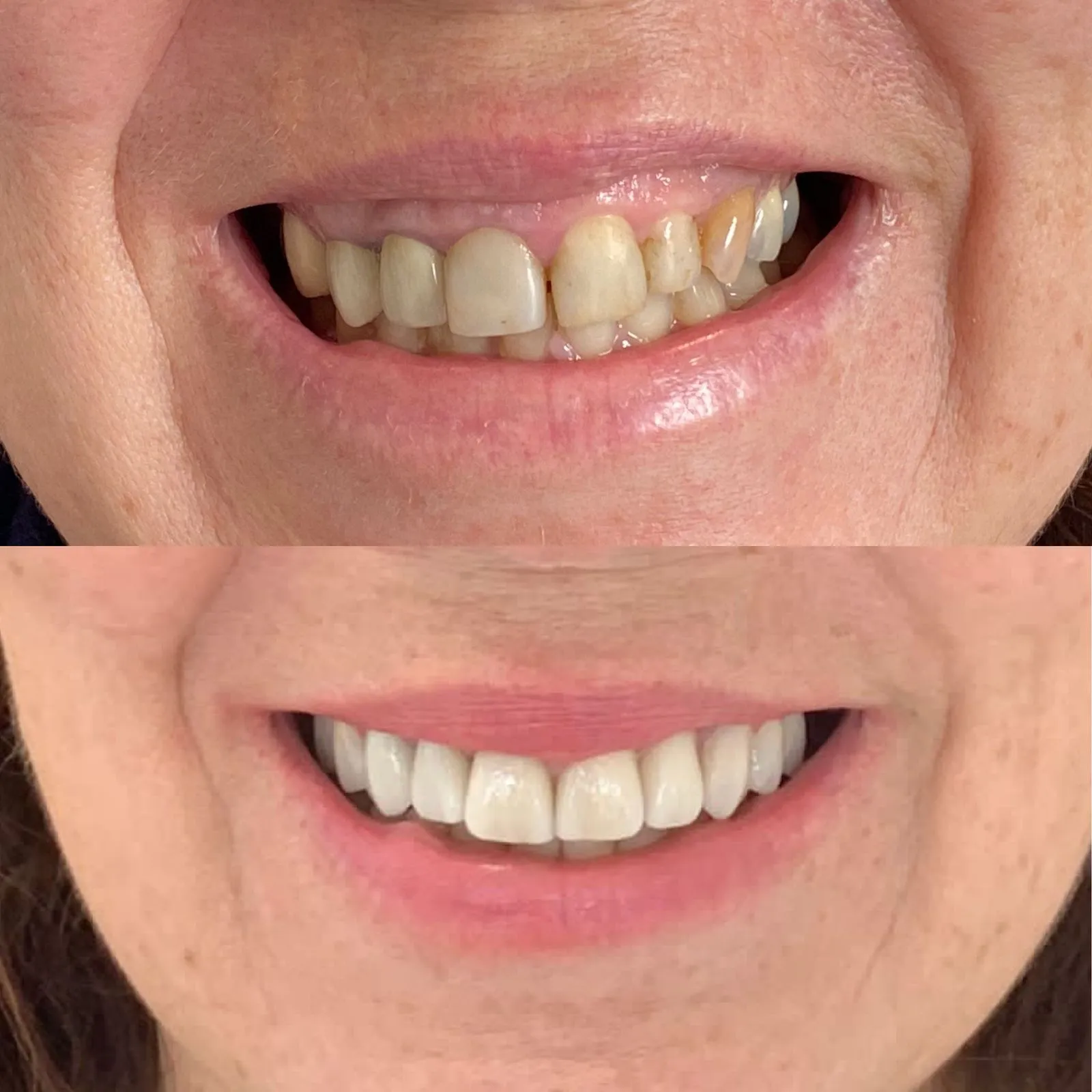 Resultado antes e depois — transformação completa com facetas estéticas
