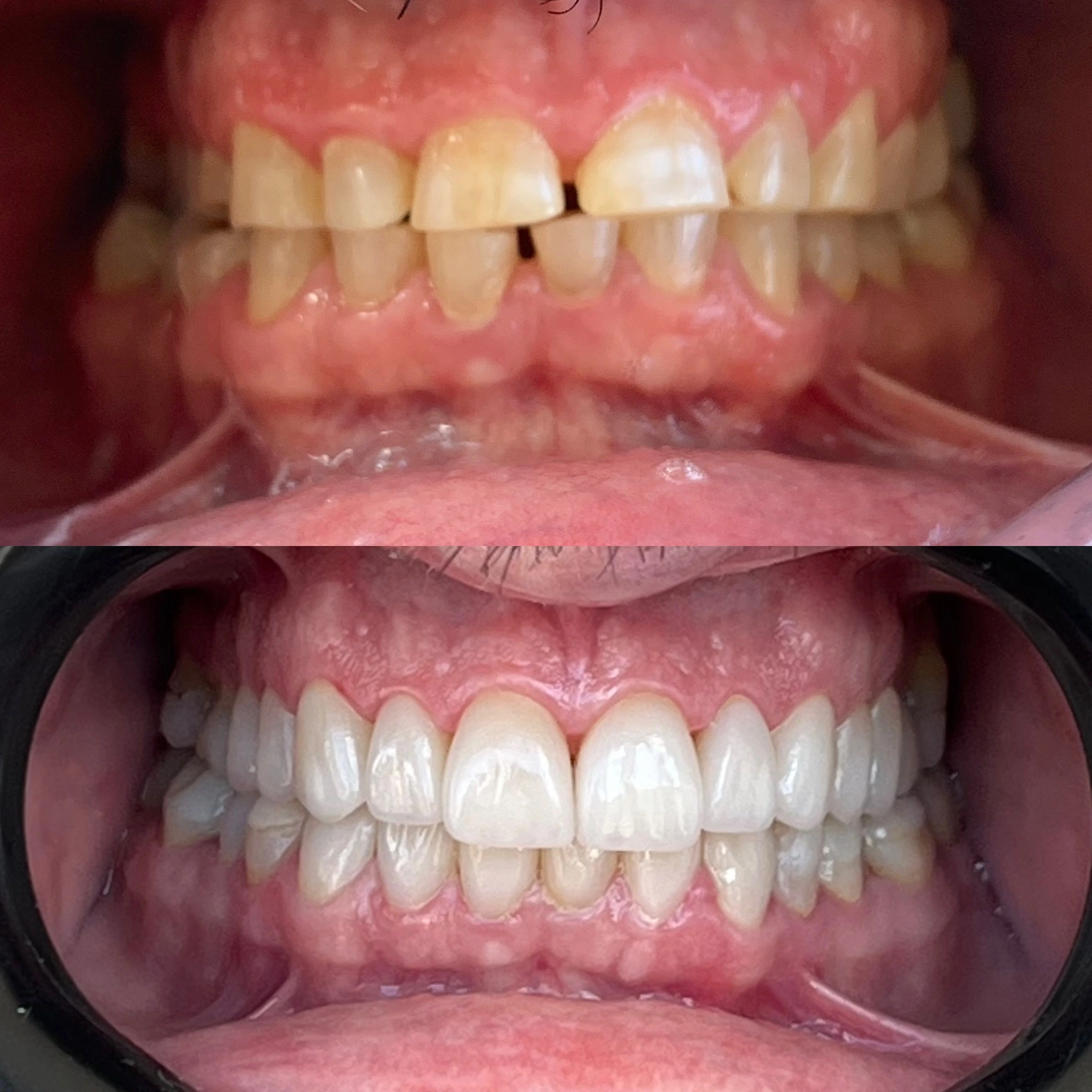 Resultado antes e depois — fechamento de diastema com resina composta