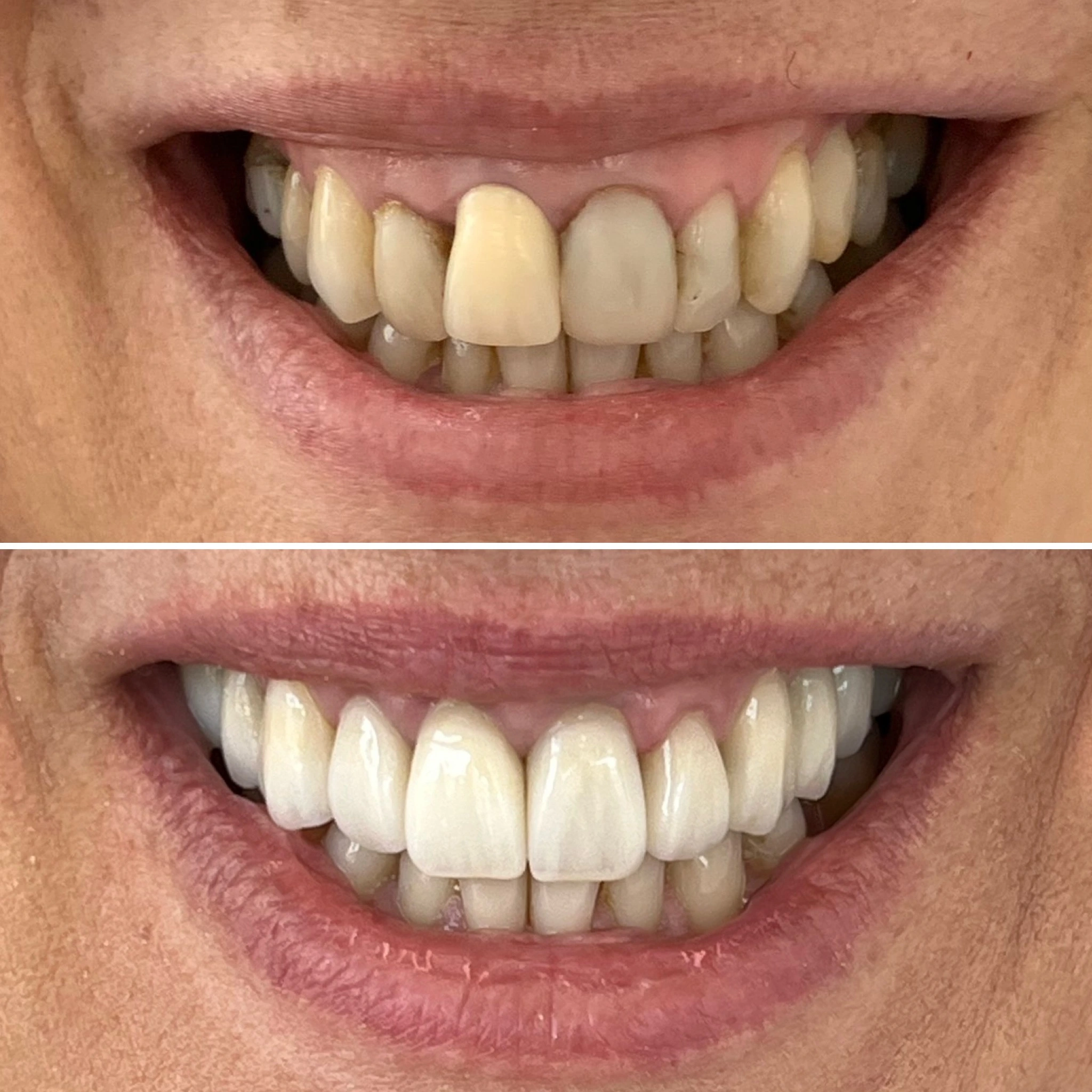 Resultado antes e depois — lentes de contato dental aplicadas ao sorriso