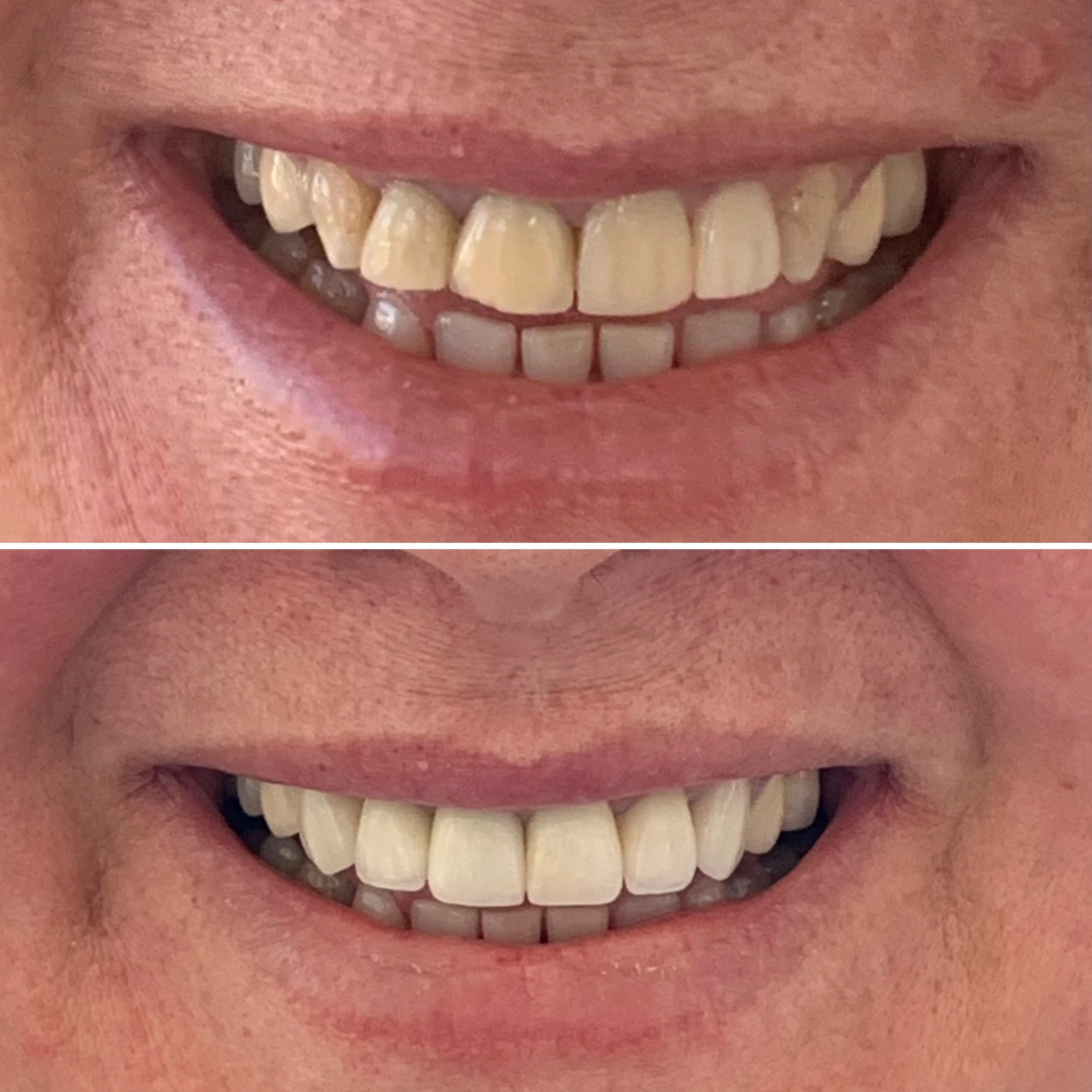 Resultado antes e depois — reabilitação estética da arcada superior