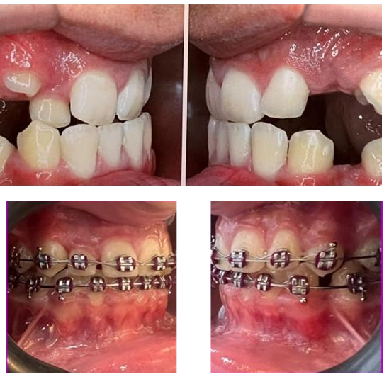 Antes e Depois Aparelho 2