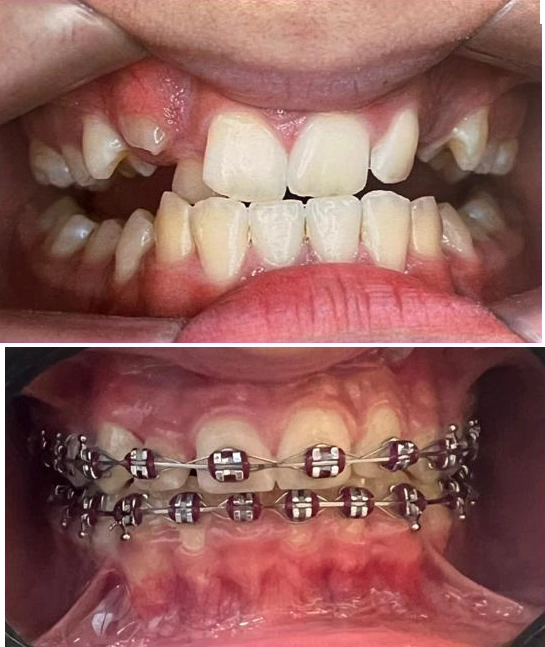 Antes e Depois Aparelho
