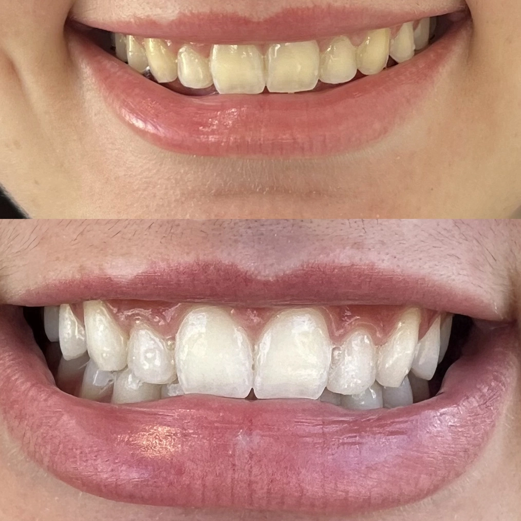 Clareamento Dental 2