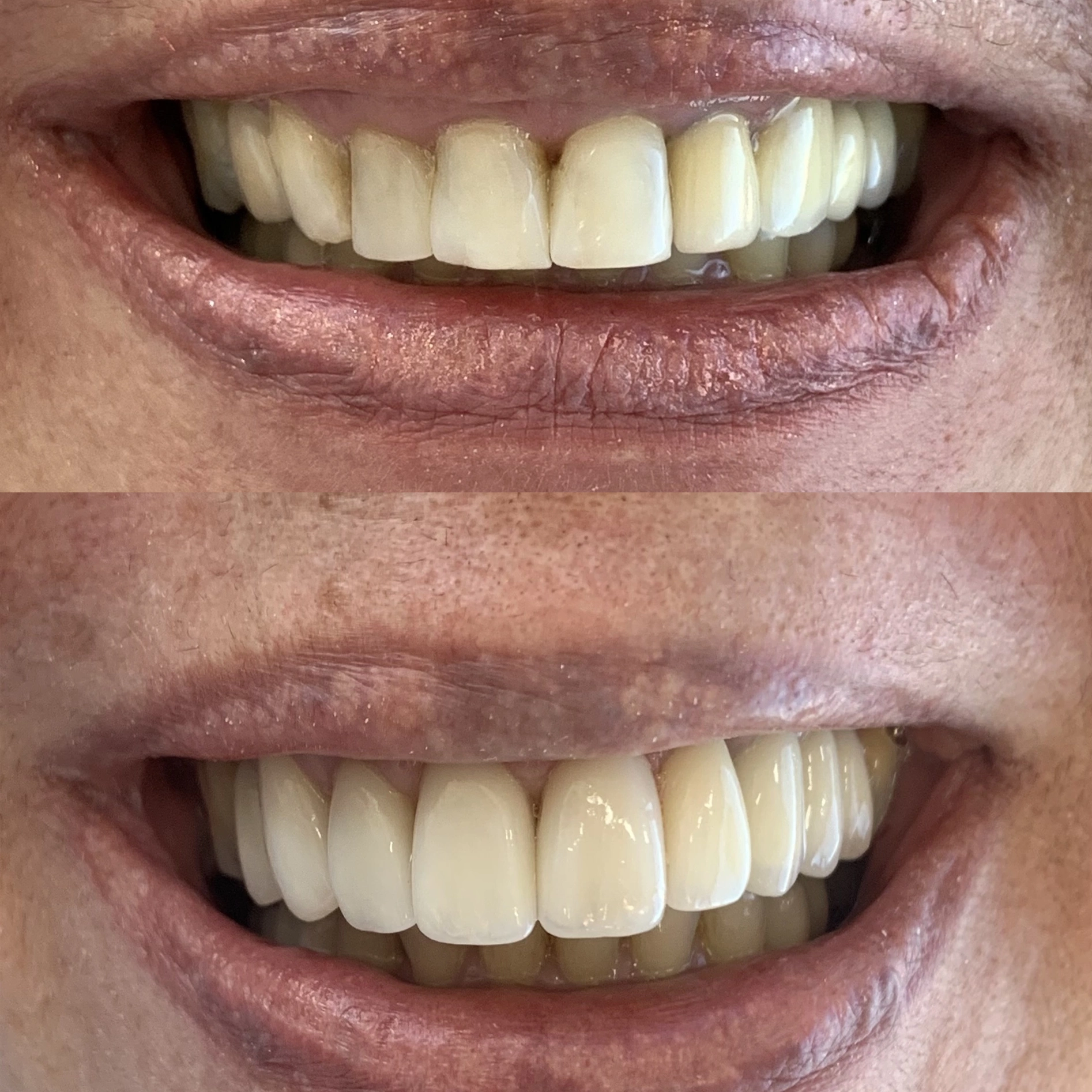 Gengivoplastia 2
