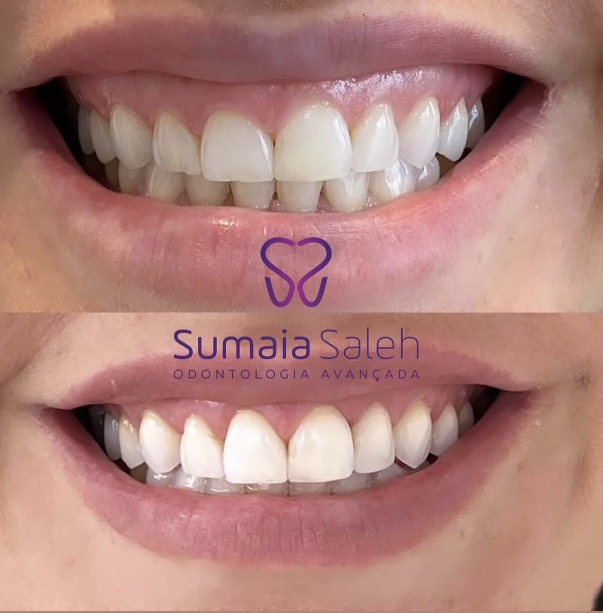 Resultado antes e depois — reabilitação oral com gengivoplastia