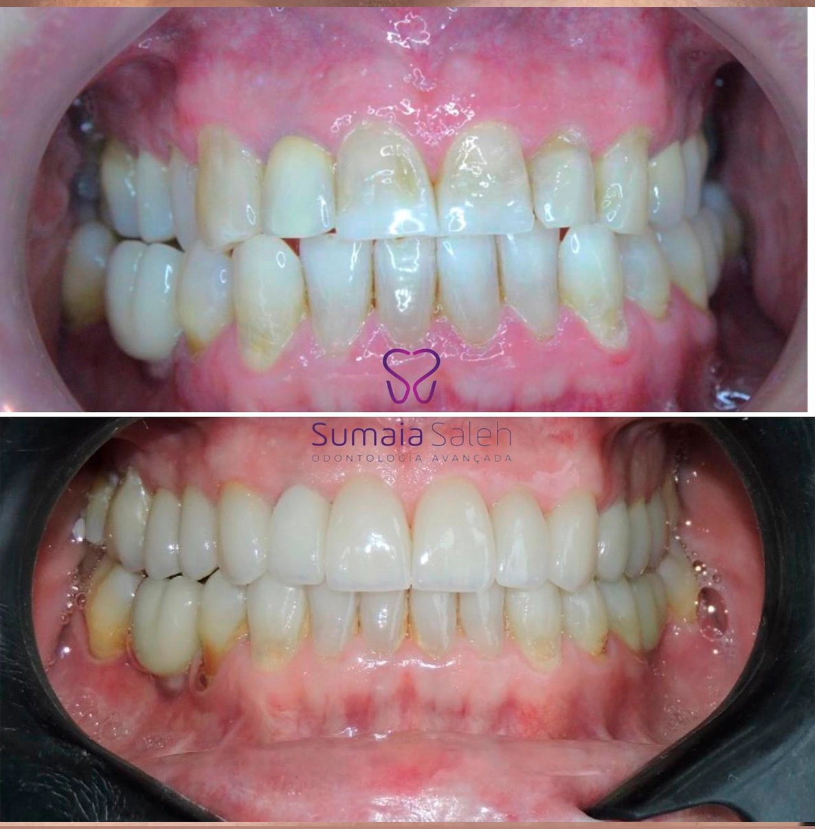 Resultado antes e depois — renderização digital de facetas de porcelana